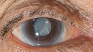 New eye drops may help treat cataracts [upl. by Lane]