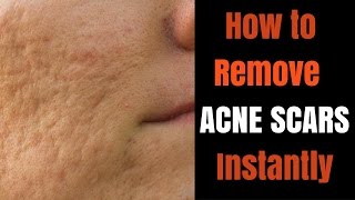 Instant acne scar removal [upl. by Kciredohr]