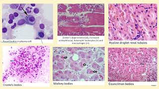 Mucoid amp Hyaline Degeneration [upl. by Brodench]