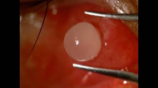 AIOC2024  VT490  Dr Birendra Prasad Kashyap  Subconjunctival cysticercosis recognition and [upl. by Ahsekar]