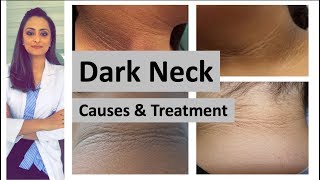 dark neck  causes treatment  Home remedies  Dermatologist Dr Aanchal Panth [upl. by Bullivant]