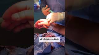 Snuff Box Closure by the Best Our team shows you TR band closure for Snuff Box Radial Access [upl. by Aindrea]