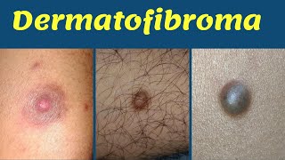 Dermatofibroma treatment hard bump on leg  चमड़ी में सख़्त गाँठ का कारण  इलाज  Dr Uttam Lenka [upl. by Janet194]