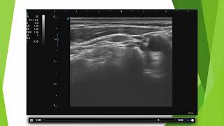 Adénopathie cervicale en échographie [upl. by Lowson]