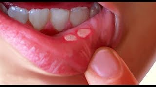 Ulcer ULCERATIVE LESIONS OF THE ORAL CAVITY [upl. by Wildon570]