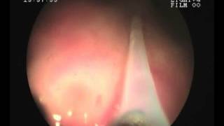 Video Tour Sigmoidoscopy and Polypectomy  wwwrkgastrolivercarecom [upl. by Yenal]