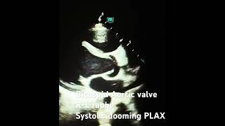 Bicuspid aortic valve with RL coronary cusps fusion cardiology echocardiography medicine [upl. by Lawan]