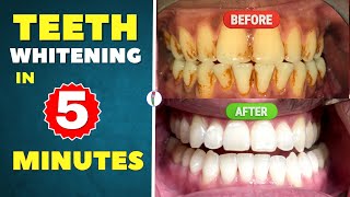 Teeth Whitening at Home 100 effective  Teeth whitening products  Professional teeth whitening [upl. by Akcirre]