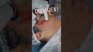 DERMAPEN ✅ Una gran alternativa para eliminar CICATRICES DE ACNE 🔥 Shorts [upl. by Beore157]