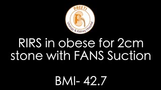 RIRS in obese for 2cm stone with FANS Suction BMI 427 [upl. by Namajneb]