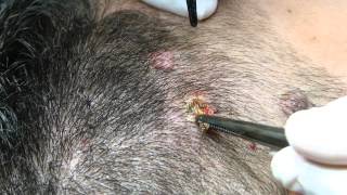 Eliminacion de Nevus Con Láser C02 [upl. by Talie502]