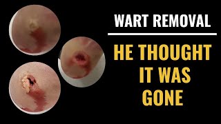 Wart Removal  He thought it was gone [upl. by Drye]