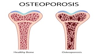 OSTEOPOROSIS Causes Diagnosis Treatment and Prevention Gary Kraus MD Back and Neck Houston TX [upl. by Acinorav135]