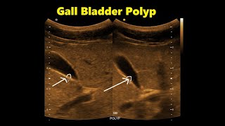 Tiny Gall Bladder Polyp  Ultrasound  Case 02 [upl. by Anaxor]