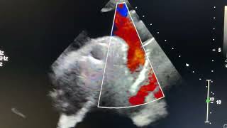 Bicuspid aortic valve with severe aortic regurgitation [upl. by Itteb759]