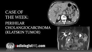 Case of the Week Perihilar CholangiocarcinomaKlatskin Tumor CT amp MRI [upl. by Ojeibbob]