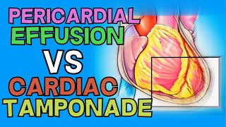 PERICARDIAL EFFUSION vs CARDIAC TAMPONADE  EXPLAINED IN 5 MINUTES Becks Triad Causes Diagnosis [upl. by Yevette759]