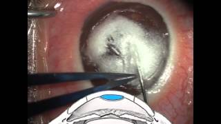 Donor cornea preparation in partial big bubble DALK  Video abstract 52395 [upl. by Goldfarb]