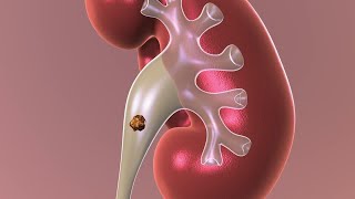 Observation Nonsurgical Approach to Kidney Stones [upl. by Sonaj877]