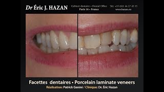 Facettes dentaires  Porcelain laminate veneers Paris France [upl. by Eanahc]