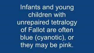 Tetralogy of fallot TOF [upl. by Callean]