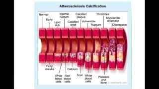 CTCAG Part 4 positive coronary artery remodeling [upl. by Ardua]