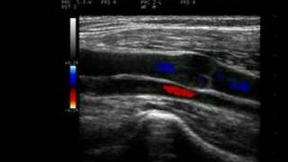 Phlebology Biosound Esaote MyLab 25 Venous Duplex [upl. by Khalid]