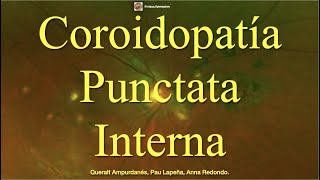 Coroidopatía Punctata Interna [upl. by Deragon233]