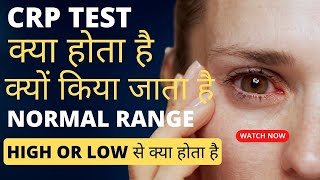 CRP test kya hota hai  crp test in hindi  crp test normal range  crp high hone se kya hota hai [upl. by Laertnom]