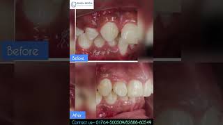 Braces before amp after ytshort orthodontist trendingshorts [upl. by Woodall]