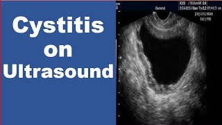 Cystitis on Ultrasound [upl. by Carmine]