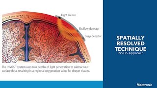 INVOS™ technology overview pt 2 How does the monitor localize oxygen saturation measurement [upl. by Aihtnic]