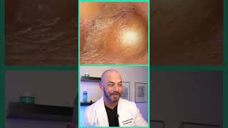 Doctor reacts to juicy cyst pop dermreacts doctorreacts pimplepop [upl. by Aztiray]