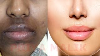 How To Remove Dark Black patches Dark SpotsHyper pigmentation Around Your Mouth  PRIYA MALIK [upl. by Esertal276]