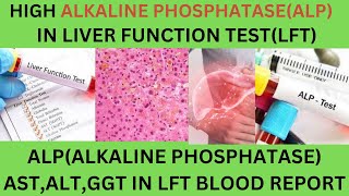 Liver Function Test Report Interpretation LFTsASTALTALP CAUSES OF HIGH LOW ALKAINE PHOSPHATASE [upl. by Ahteres]