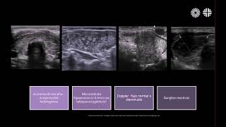 Radiología en 5 minutos Tiroiditis de Hashimoto [upl. by Onileba569]