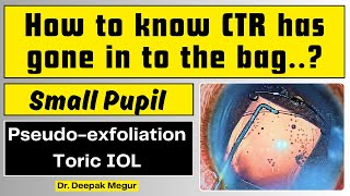 Phaco and Toric IOL in an eye with Pseudoexfoliation and Dense Cataract Dr Deepak Megur [upl. by Nnylasor516]