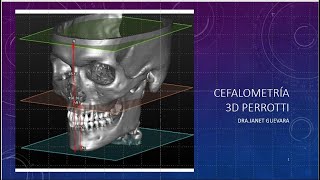 Cefalometría 3D PERROTI Dra Janet Guevara Reyes [upl. by Ycram]