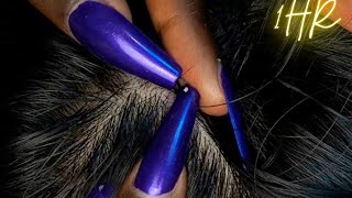 ASMR 1 HR Super Attentive NITPICKING SCALP WHITEHEADS  soft spoken  zoomed [upl. by Eecal]