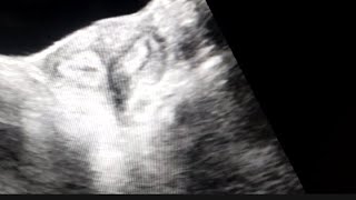 Bicornuate uterus on Ultrasound [upl. by Okihcas]