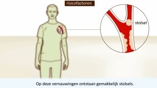 Trombose  Symptomen en behandeling [upl. by Ecyned]