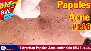 Extraction Papules Acne under skin MALE clients  Acne Treatment 116 [upl. by Kceb]