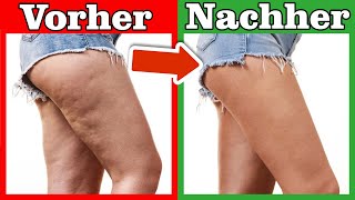 7 Lebensmittel die deine CELLULITE bekämpfen 💥 Schnell und einfach 🤯 [upl. by Ailecra956]