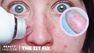 Pore Vacuum For Blackheads Has BuiltIn Microscope  The Zit Fix [upl. by Nivart662]