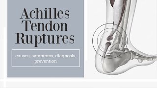 Achilles tendon rupture causes symptoms diagnosis and prevention [upl. by Ennire48]