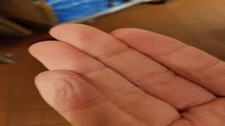 how to get rid of burning sensation on fingers [upl. by Allenaj]