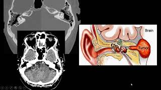 Schwannoma do acústico [upl. by Esirehs750]