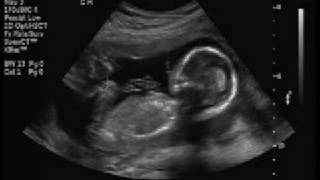 Baby Girl Ultrasound at 18 Weeks [upl. by Andert68]