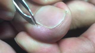 Ingrown Toenail Removal [upl. by Kajdan]