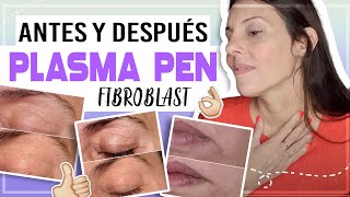 PLASMA PEN FIBROBLAST ANTES Y DESPUÉS  plasma pen  plasmapen plasmafibroblast CarolinaTV [upl. by Anirak]